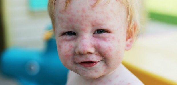 Через відсутність вакцини у Чернівецькій області зросла кількість хворих на краснуху